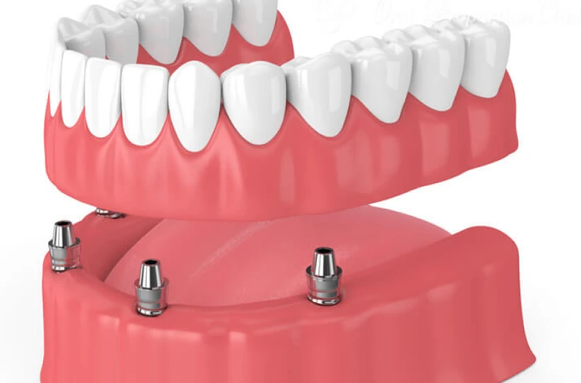 インプラントオーバーデンチャー