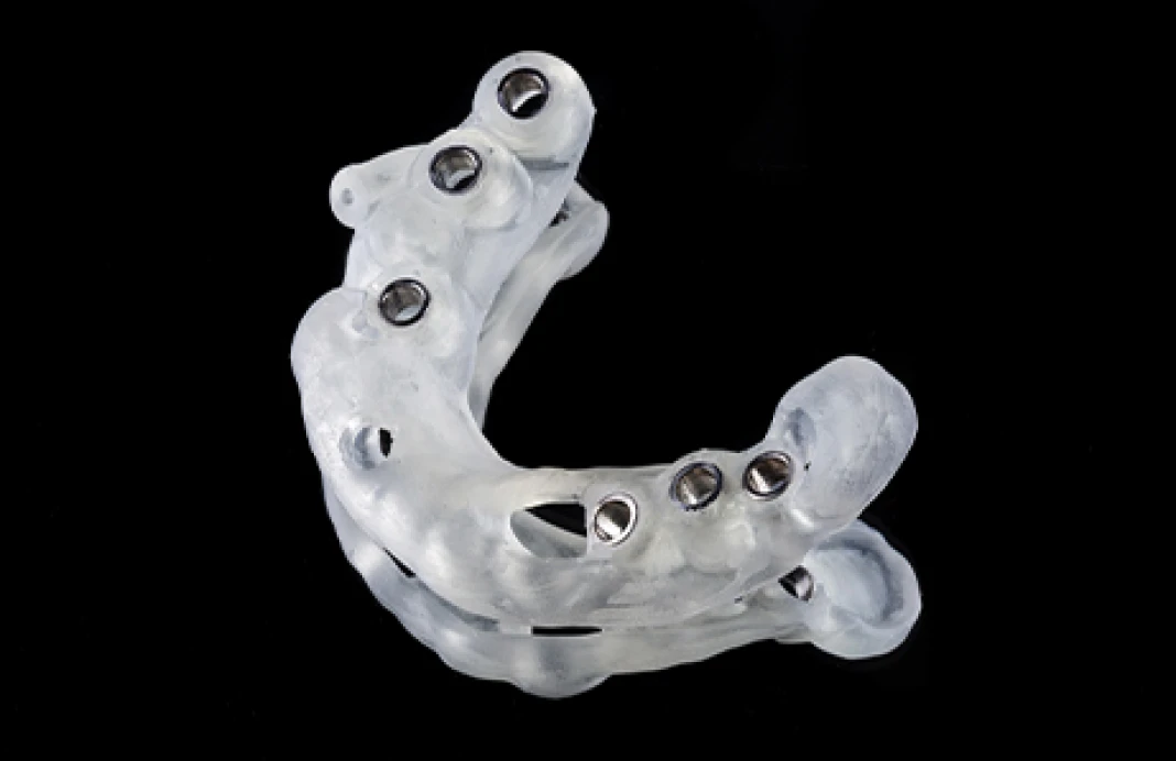 当院のインプラント